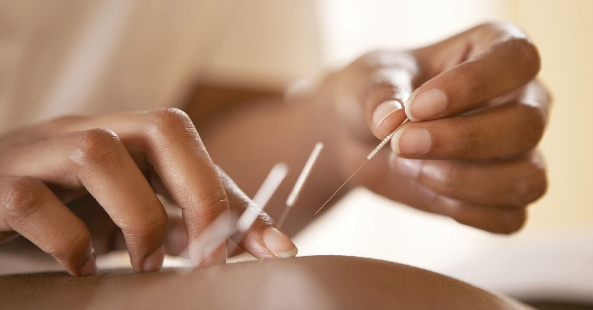 Acupuncture for IVF Yin Wellness Fertility Acupuncture Brisbane