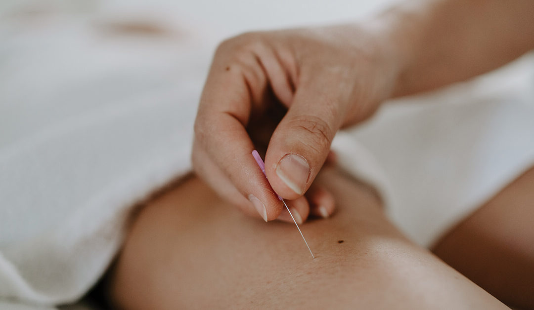 woman having pregnancy acupuncture procedure