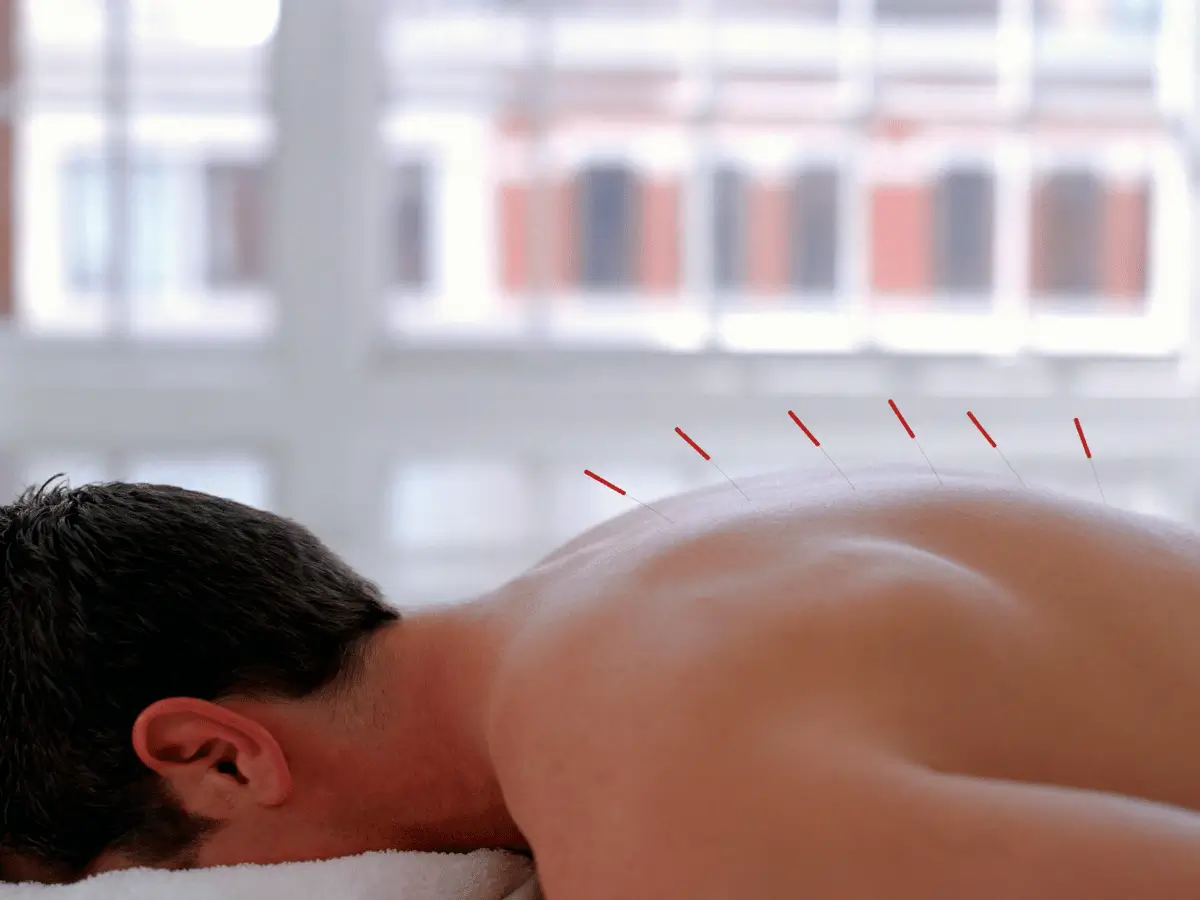 acupuncture-for-male-fertility-brisbane Man laying down and receiving acupuncture for male fertility in Brisbane